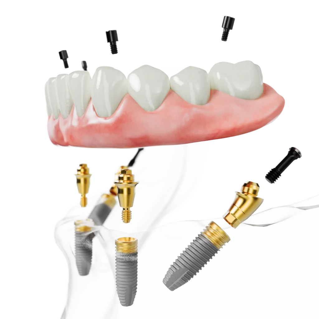 Vier Implantate für eine feste Zahnreihe Grafische Darstellung einer All-on-4® Versorgung mit vier Implantaten und festsitzender Zahnreihe.