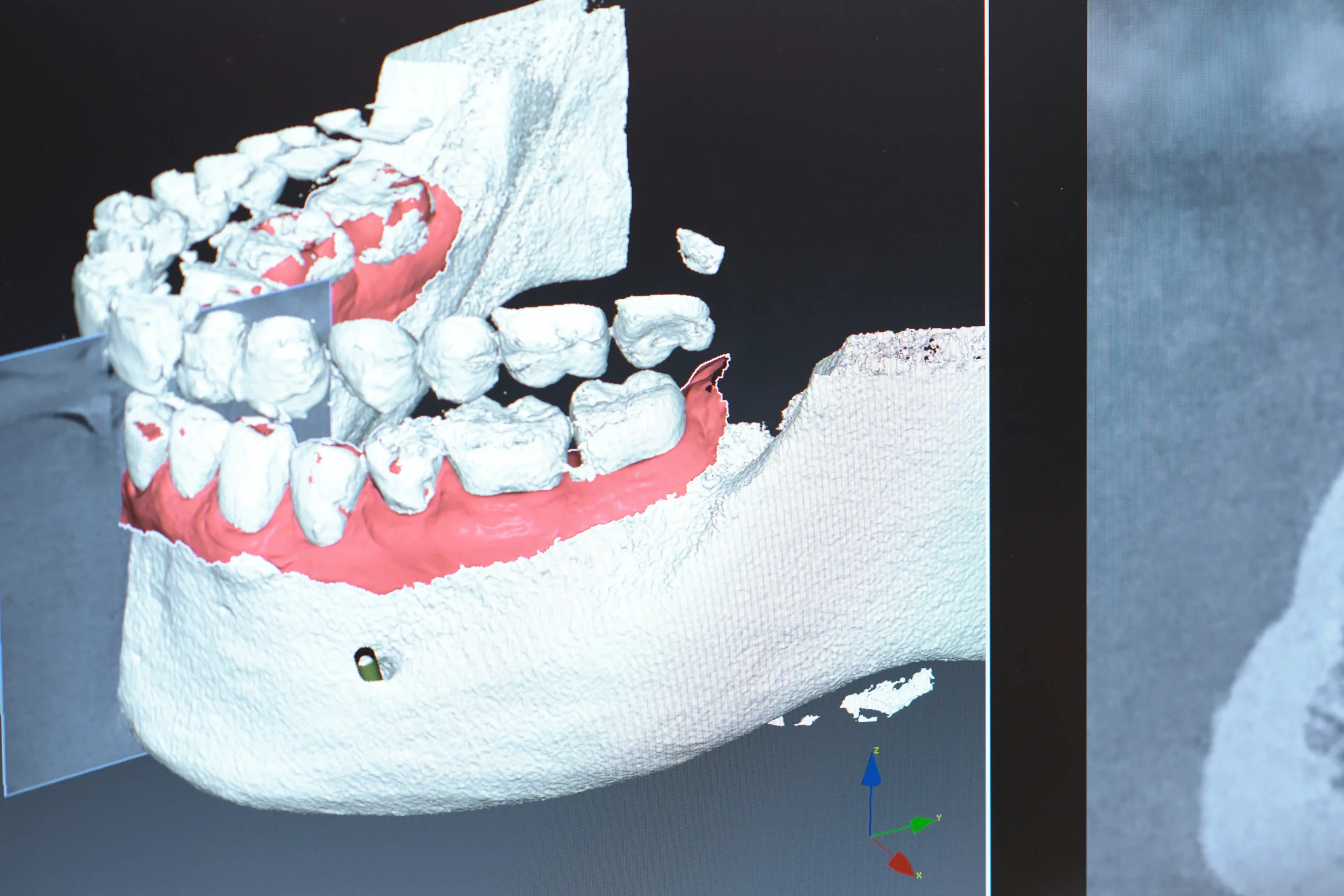 Digitales Kiefermodell zur Planung eines zahnchirurgischen Eingriffs