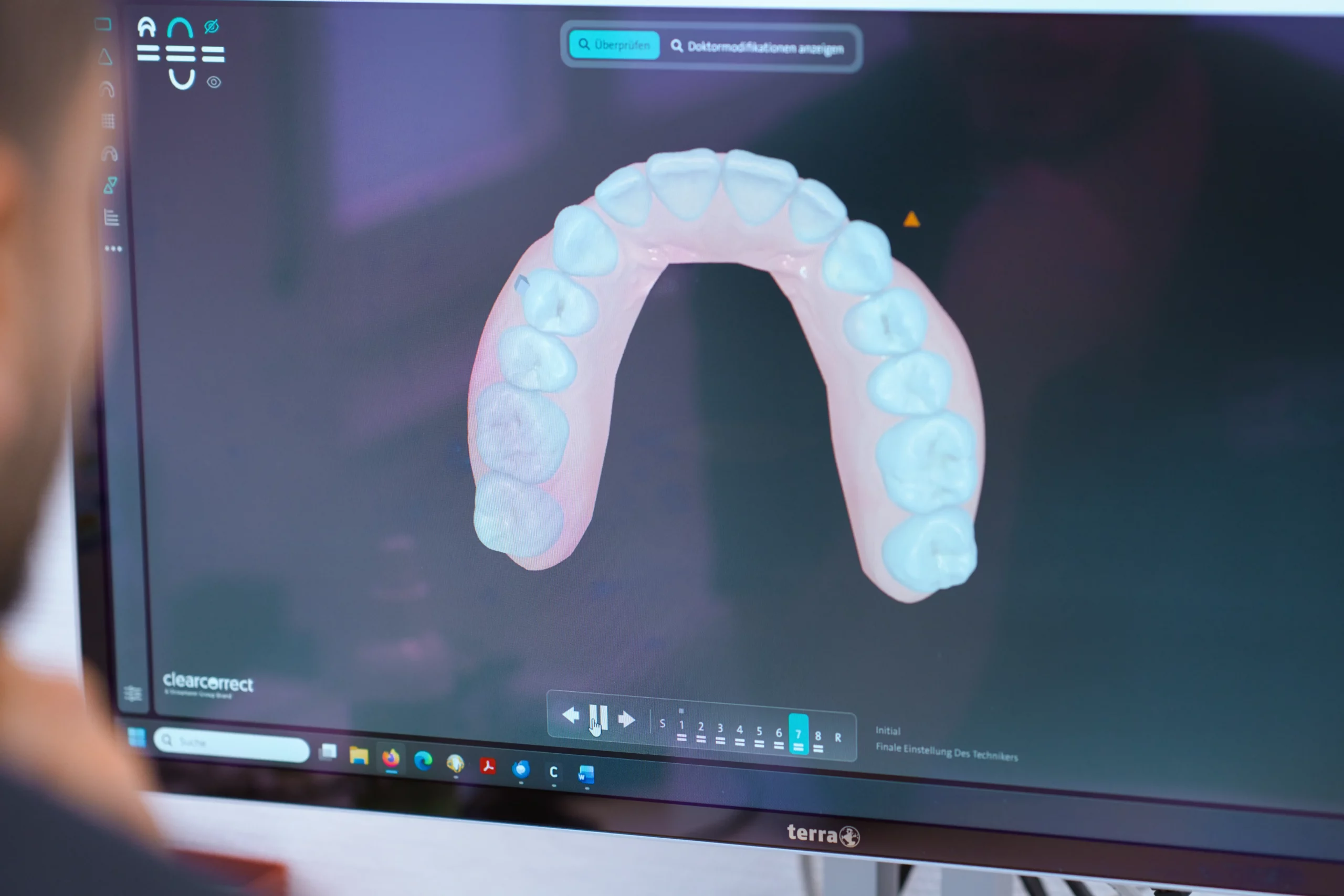 Digitales 3D-Zahnmodell zur individuellen Planung von Kronen, Brücken und weiterem Zahnersatz.